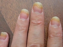Грибок ногтей на руках: фото и чем лечить